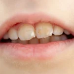 Close-up of child front teeth with yellow stains