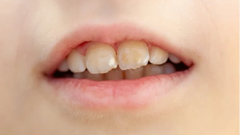Close-up of child front teeth with yellow stains