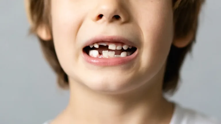 Close-up of child smiling with chipped front teeth