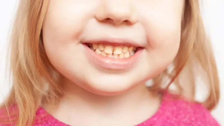 Close-up of child teeth with visible brown discoloration