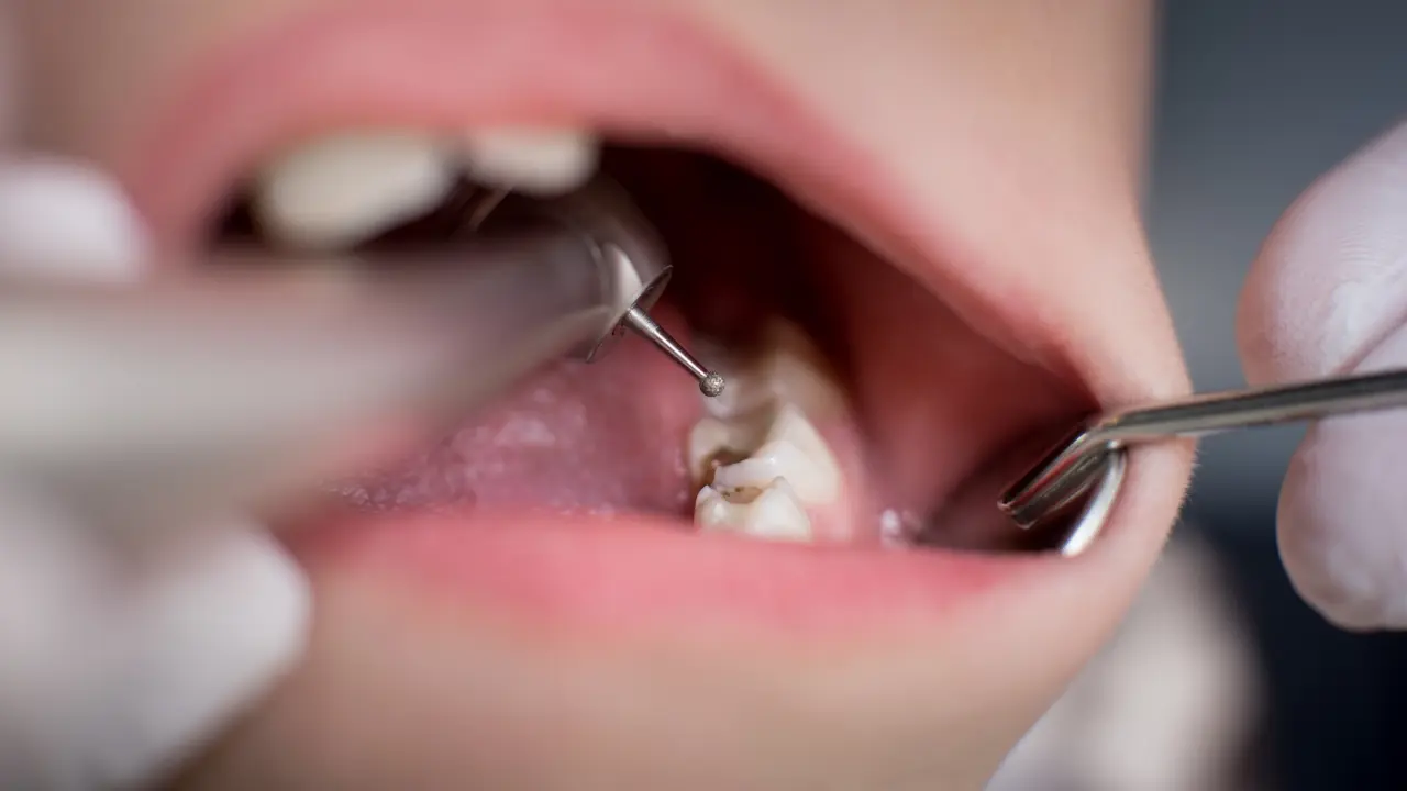 Dentist treating cavity in baby tooth with dental drill