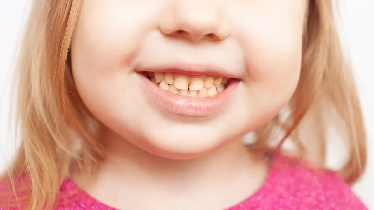Close-up of child teeth with visible brown discoloration