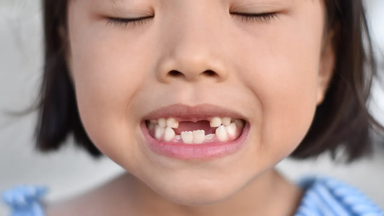 Child smiling with missing front teeth during growth stage
