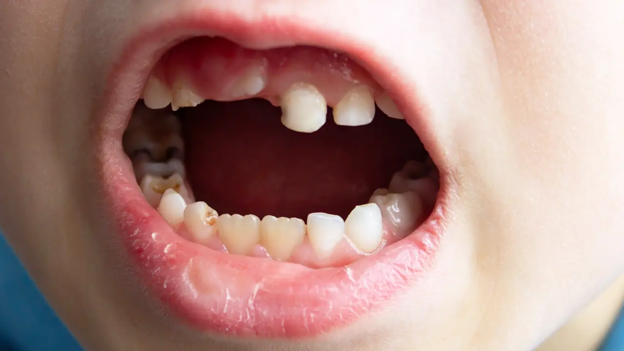 Close-up of child teeth with visible decay and cavities