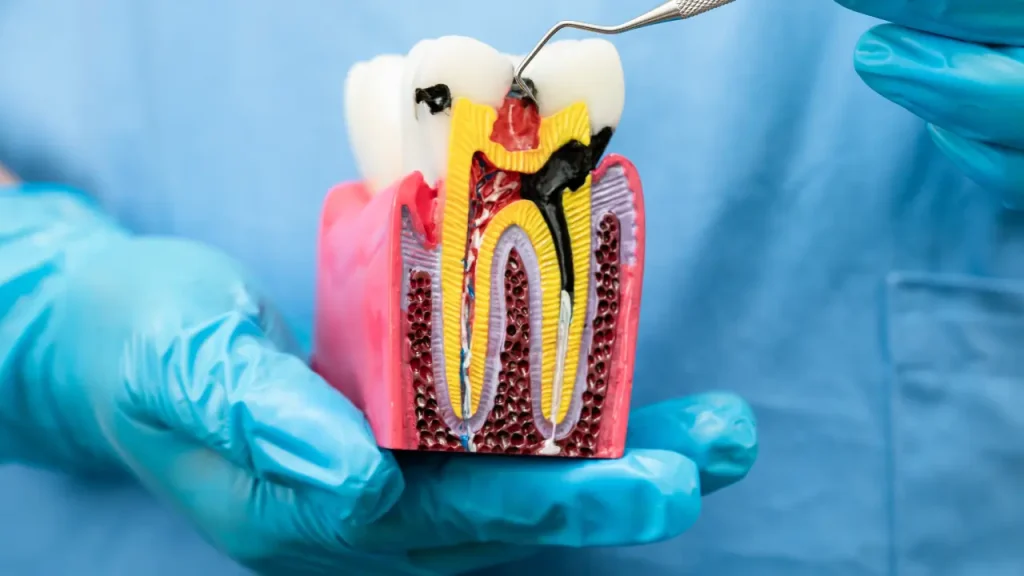What Is a Pulpotomy? (Baby Root Canal for Kids Explained)