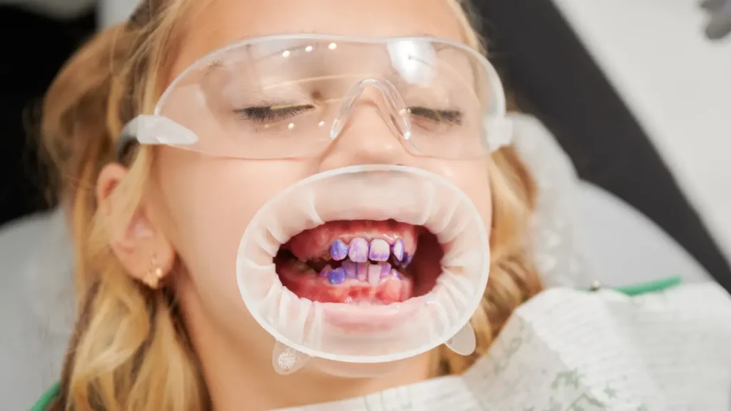 Child receiving silver diamine fluoride treatment to stop tooth decay without drilling in Dubai