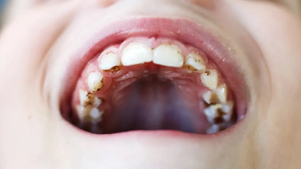 Child's teeth showing visible signs of cavities and tooth decay