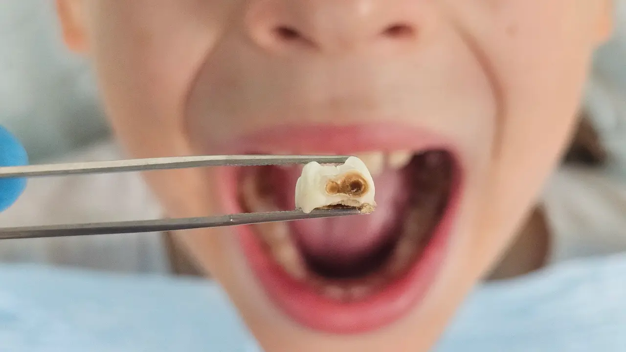 Severely decayed baby tooth removed during a child's tooth extraction procedure