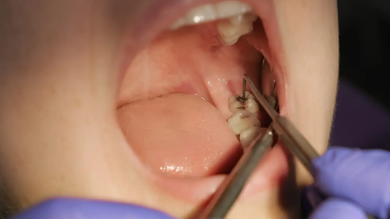 Child's tooth showing dark discoloration associated with silver diamine fluoride treatment